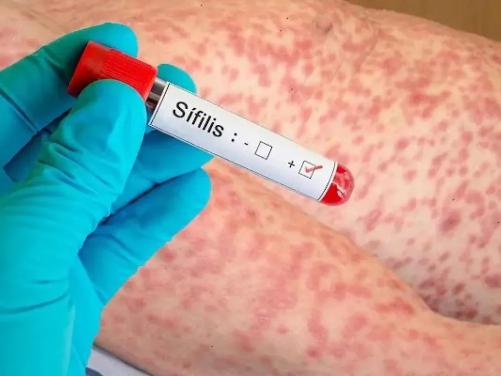 sifilis