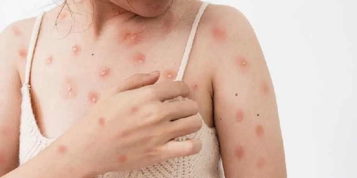 84339-que-es-la-viruela-del-mono